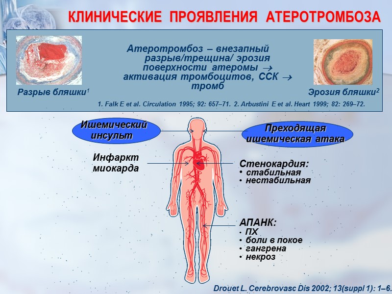 КЛИНИЧЕСКИЕ  ПРОЯВЛЕНИЯ  АТЕРОТРОМБОЗА Drouet L. Cerebrovasc Dis 2002; 13(suppl 1): 1–6. Преходящая